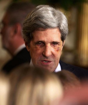 John Kerry's black eyes after having cosmetic surgery, which he denies.