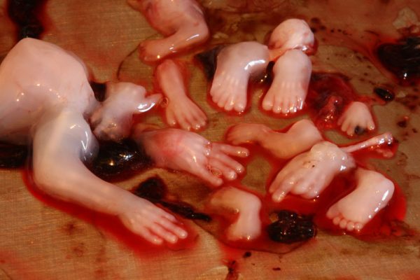 Disgusting Planned Parenthood Skank Thinks It's "Fun" to Dissect Bodies of Murdered Babies