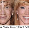 Here are the REAL picture of Kathy Griffin Before & After her extensive facial reconstruction surgery.