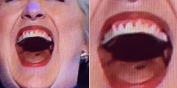 Hillary Clinton's Fake Teeth & Signs of Tongue Cancer